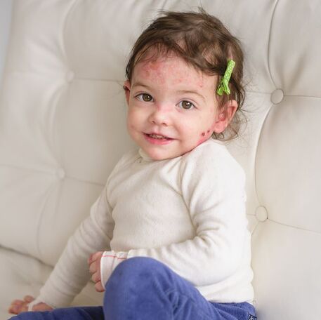 Epidermolysis Bullosa, EB,Ebyar,Clothing