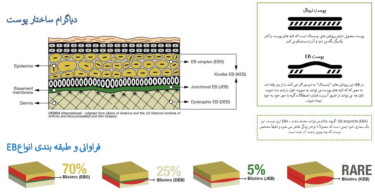 Epidermolysis Bullosa, EB,Ebyar, type of eb